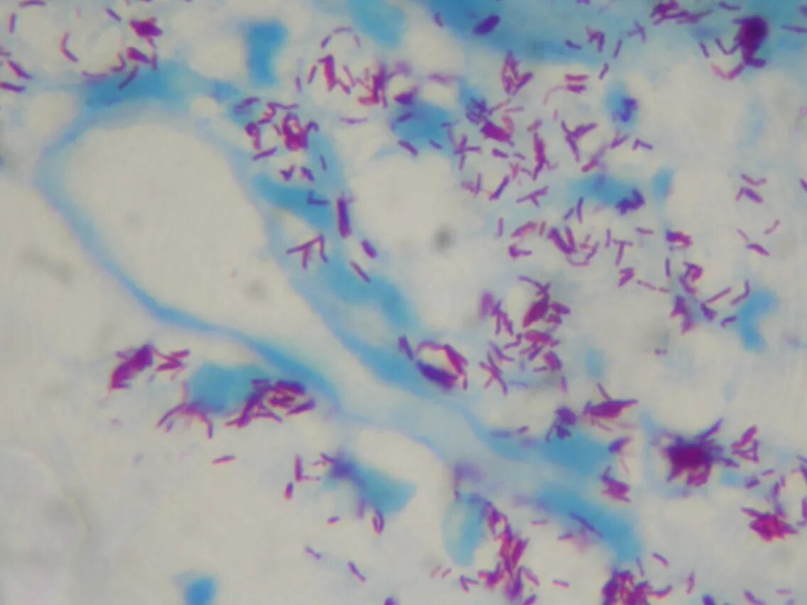 Окраска по Цилю-Нильсену Mycobacterium leprae. Микобактерии лепры микроскопия. Mycobacterium leprae микроскопия. Лепра возбудитель Mycobacterium leprae.