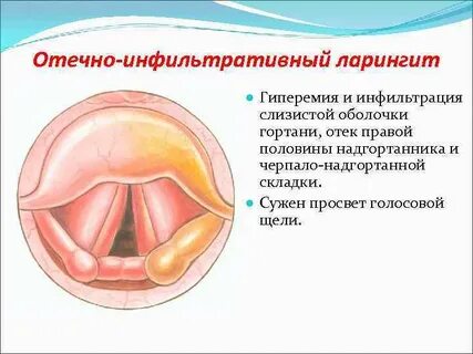 Расширяющую голосовую щель