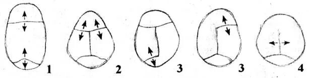 Варианты формы черепа. Долихоцефалия черепа у новорожденного. Формы головы у новорожденных долихоцефалия. Краниостеноз яйцевидная форма головы. Краниостеноз башенный череп.