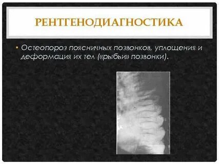 Поясничный остеопороз