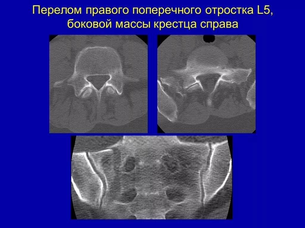Перелом s4. Перелом s4. Перелом s4. Перелом боковой массы крестца классификация. Перелом s4.