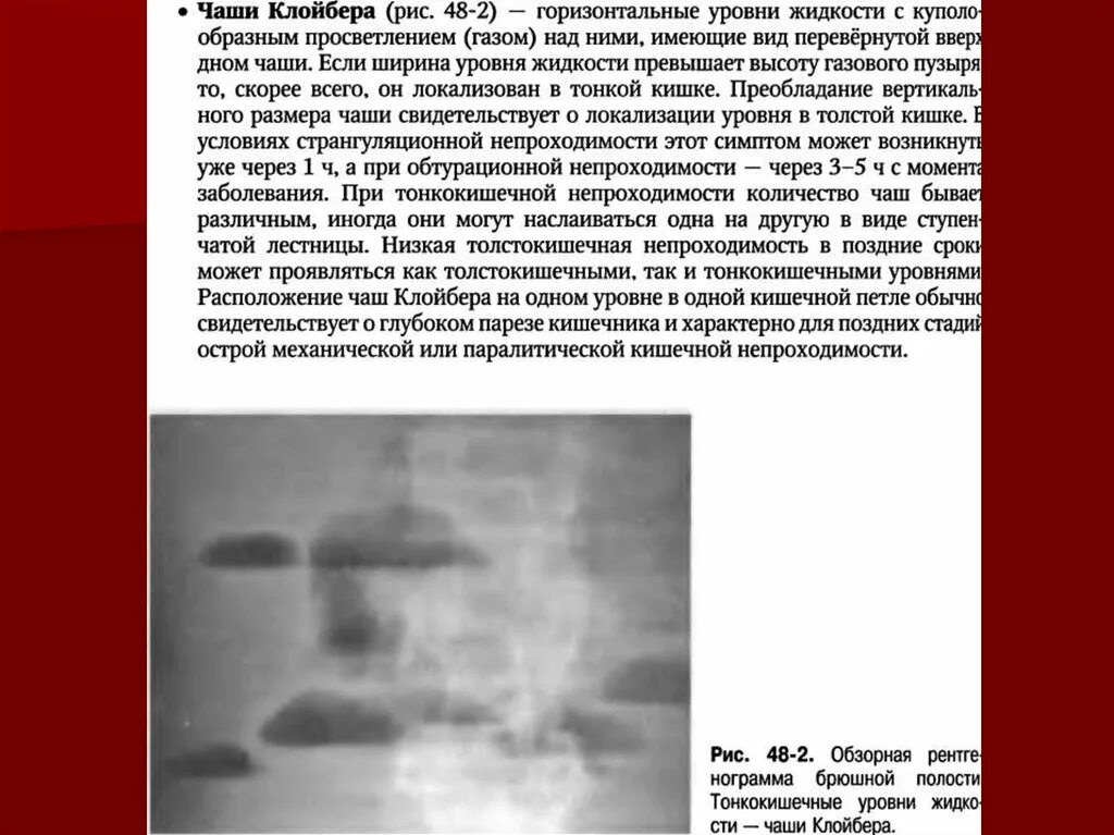 Непроходимость карта вызова. Чаши Клойбера на рентгенограмме описание. Рентген брюшной полости чаши Клойбера. Чаши Клойбера при кишечной непроходимости. Кишечная непроходимость рентген чаши Клойбера.