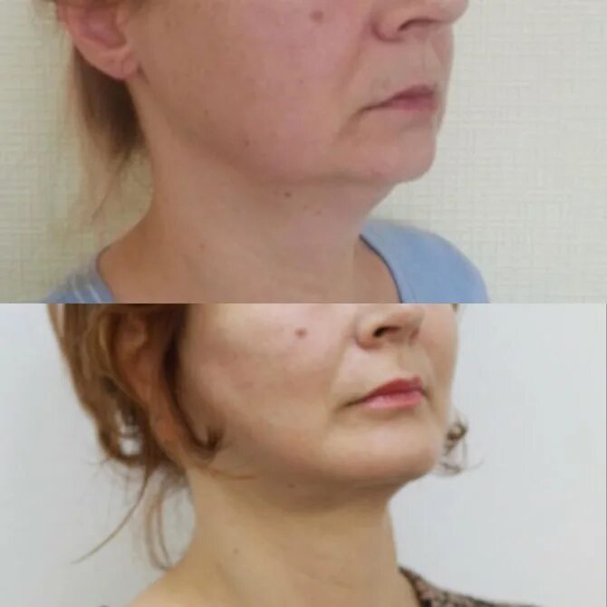 Пластика шеи нижней трети лица фото Face lift → Photos of the results before and after plastic surgery