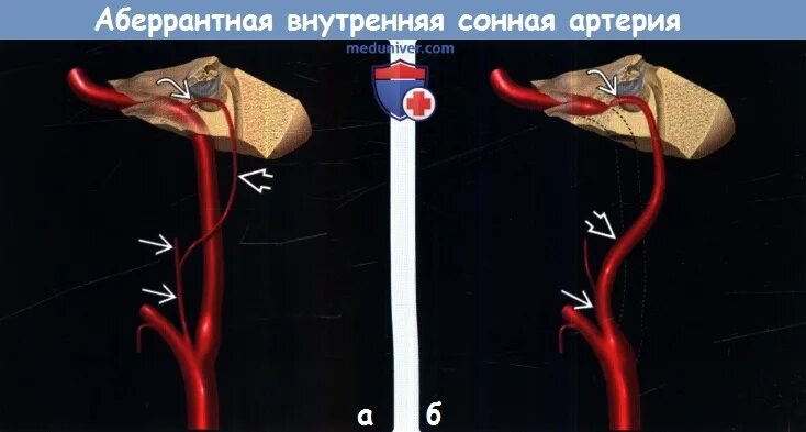 Аберрантная внутренняя Сонная артерия. С5 сегмент внутренней сонной артерии. Супраклиноидный сегмент внутренней сонной артерии. С6 сегмент ВСА.