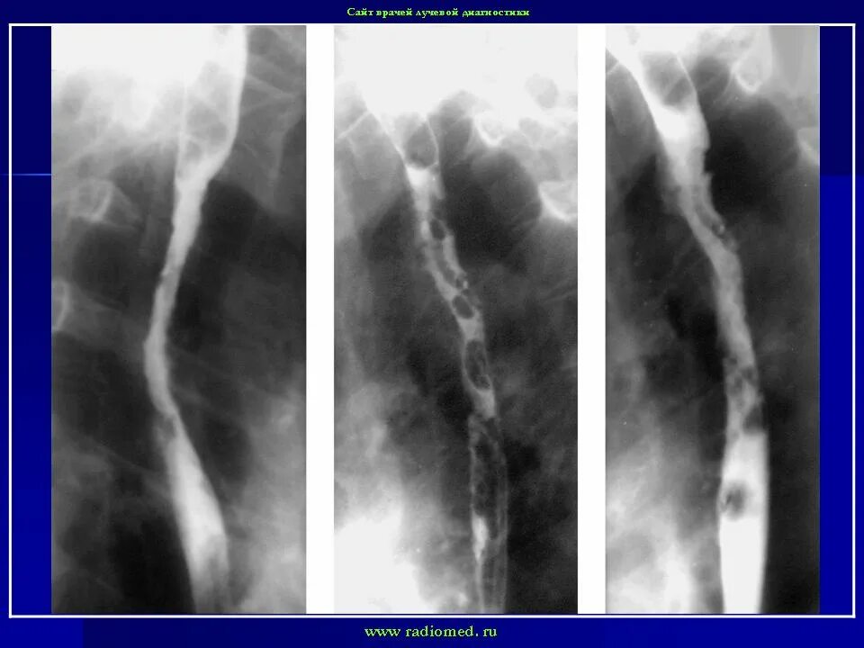 Лечение варикозных вен пищевода. Варикозное расширение вен пищевода рентгенограмма. Расширение вен пищевода рентгенограмма. Варикозное расширение вен пищевода рентгеноскопия. Варикозное расширение вен пищевода рентген.