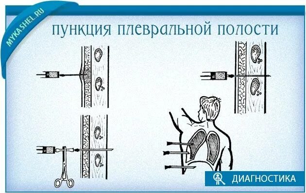 Точка пункции плевральной полости. Точка пункции плевральной полости. Методика выполнения пункции плевральной полости. Пункция плевральной полости алгоритм. Точка пункции плевральной полости.