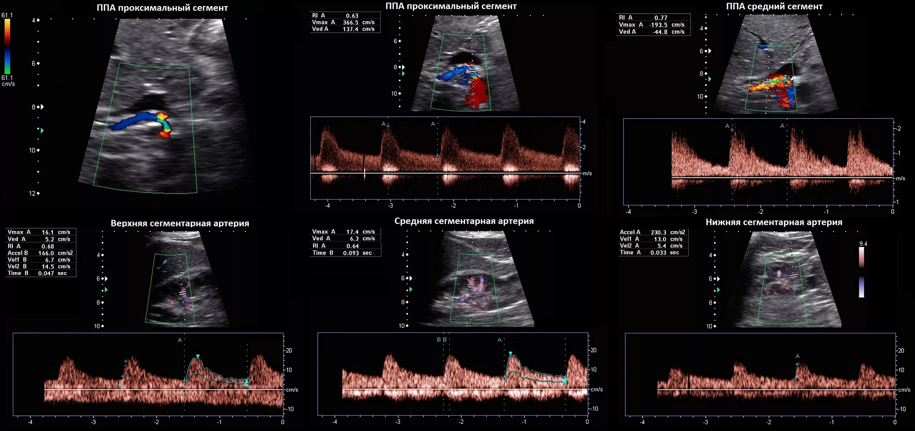 Доплер почек. Допплер почечных артерий норма. Ультразвуковая допплерография почечных вен. УЗДГ почечных артерий стеноз. Допплеровское исследование сосудов почек.