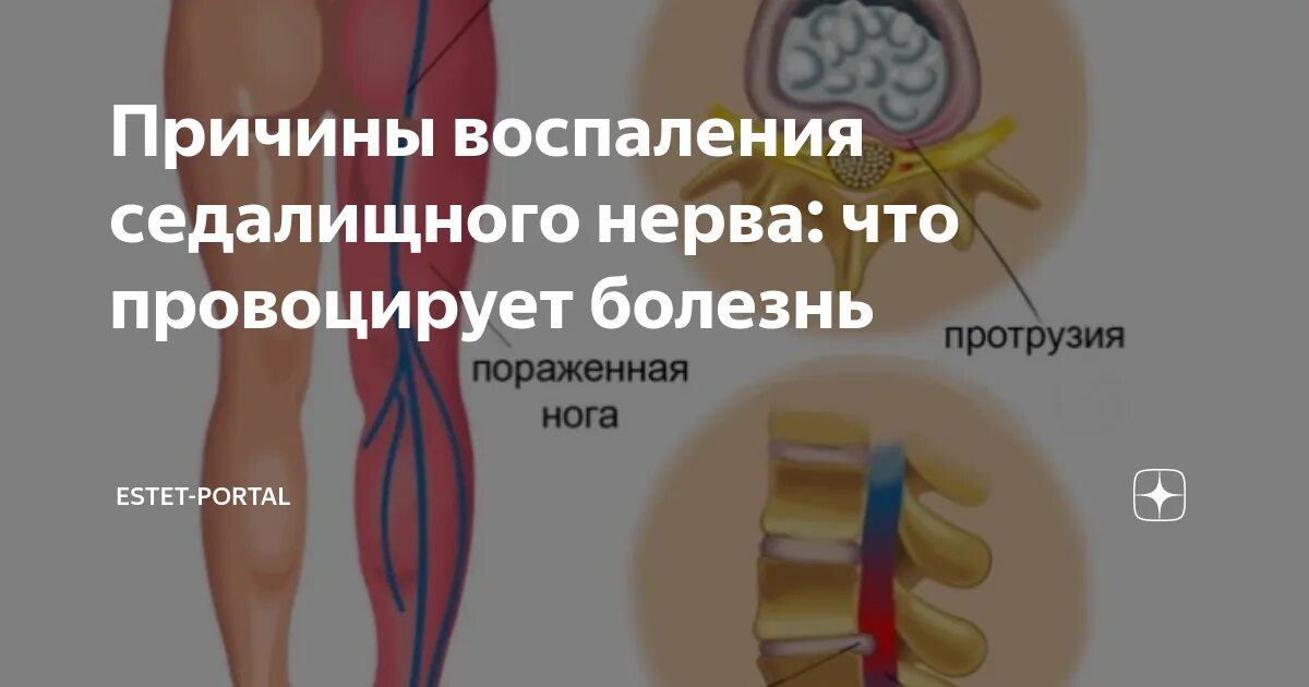 Воспаление седалищного нерва. Воспалился седалищный нерв. Воспаление воспаление седалищного нерва. Седалищный нерв симптомы.