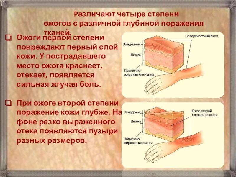 Установите соответствие степени ожога. Ожог 4 степени глубина поражения. Ожог 2 степени глубина поражения ткани. Степень поражения кожи ожогом.