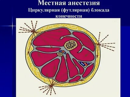 Анестезия конечностей