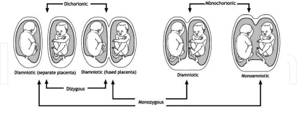 Двойная ди ди. Монохориальная многоплодная беременность. Монохориальная моноамниотическая Близнецы. Дихориальная диамниотическая двойня. Однояйцевая двойня.