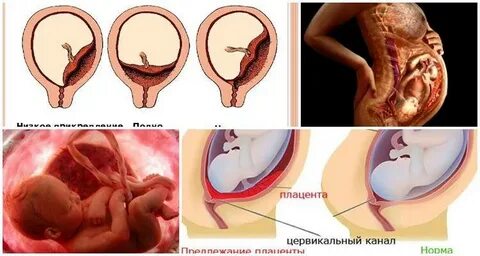 Стенка матки плод