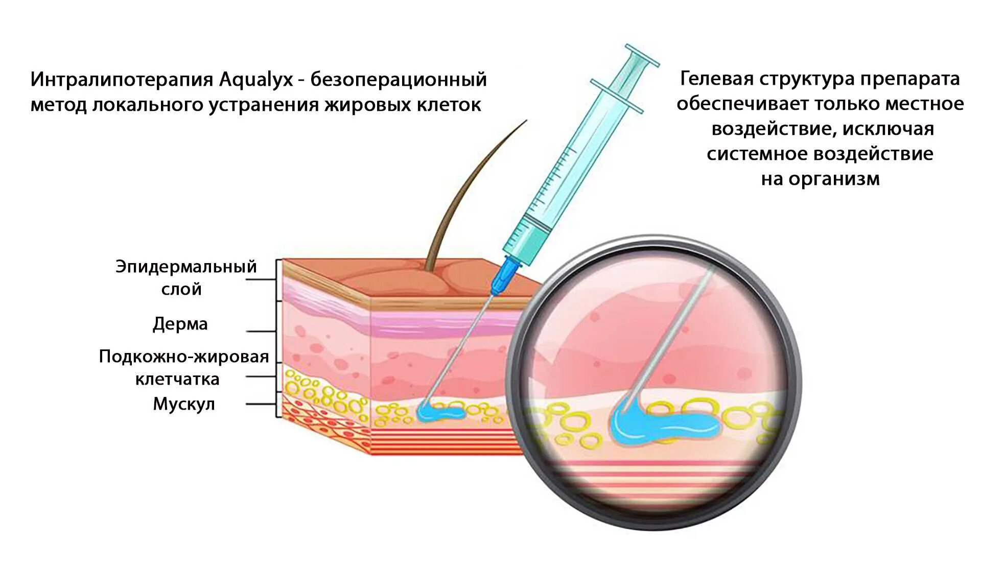 Липолитики что это. Интралипотерапия акваликс. липолитики схема введения в лицо. прямые и не прятмые липолитки. зоны введения липолитиков на лице.