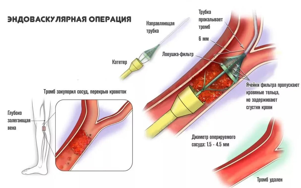 Сколько стоит тромба