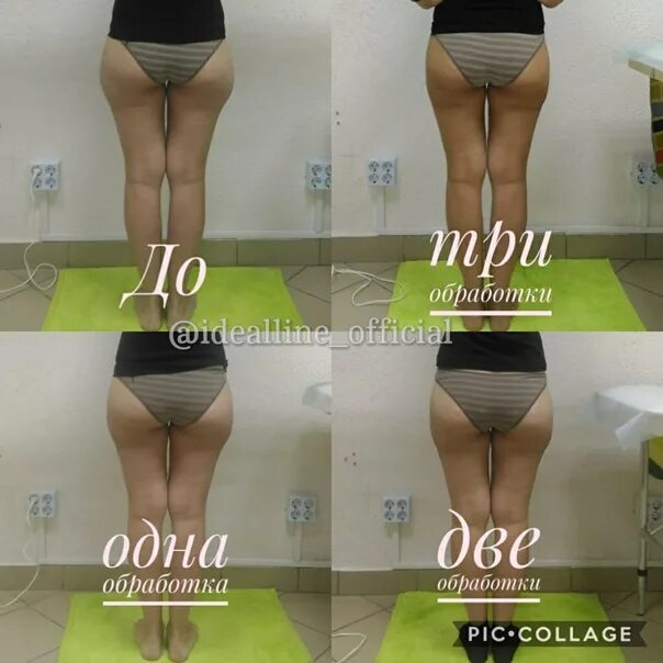 Липосакция галифе до и после отзывы Галифе Это Жир 49 фото