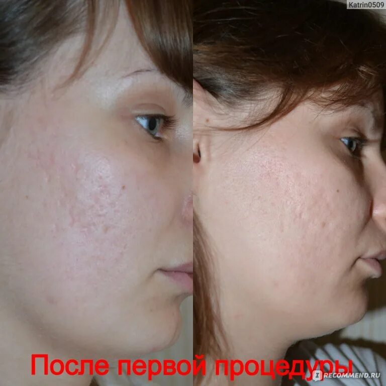Шлифовка кожи лица до и после Лазерная шлифовка что это такое ❓ суть процедуры, показания и противопоказания