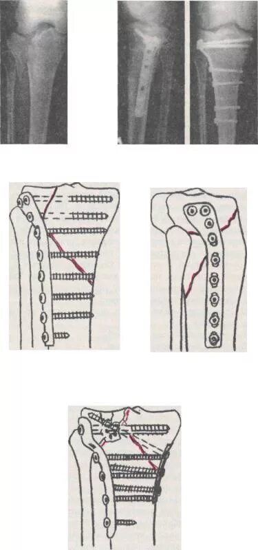 Остеосинтез большеберцовой кости штифтом. Остеосинтез мыщелка большеберцовой кости. Импрессионный перелом мыщелка большеберцовой кости. Остеосинтез диафиза большеберцовой кости пластиной. Остеосинтез мыщелка