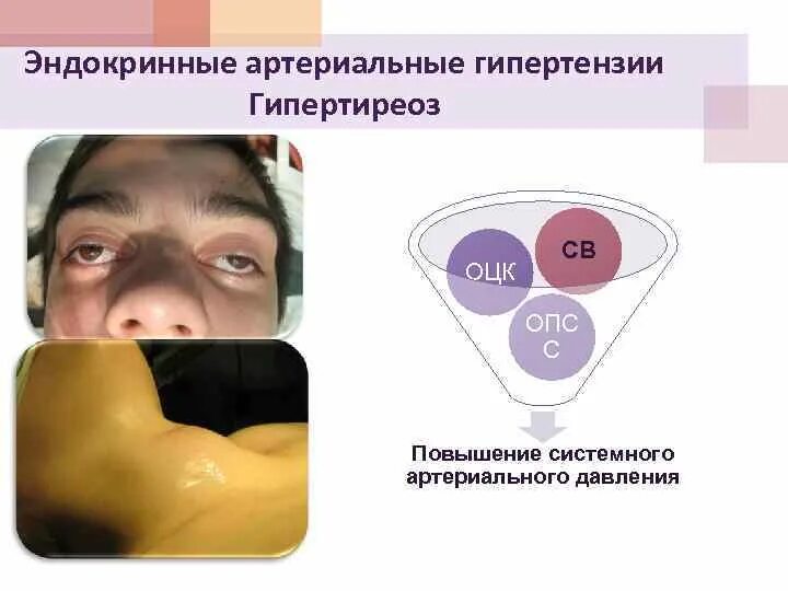Гиперфункция щитовидной железы патогенез. Механизм развития симптомов при тиреотоксикозе. Для гипертиреоза характерно. Патогенез артериальной гипертензии при гипотиреозе. Гипертиреоз щитовидки.