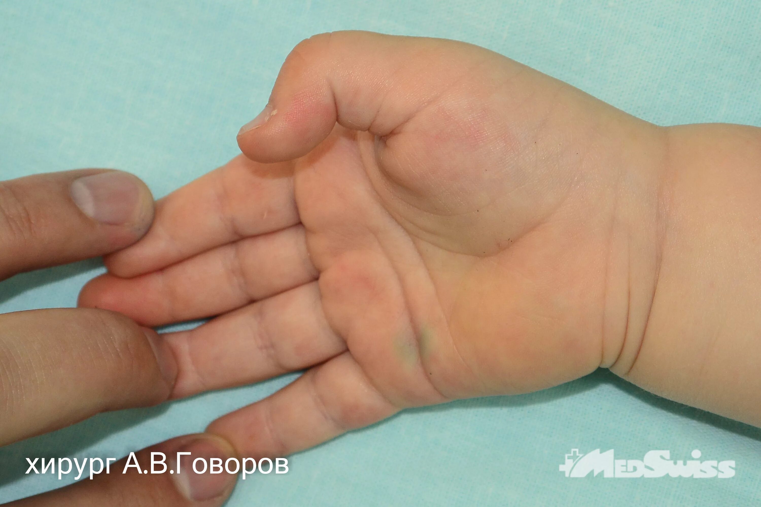 Болезнь нотта форум. Стенозирующий лигаментит 1 пальца. стенозирующий лигаментит нотта. стенозирующий лигаментит. болезнь нотта. лигаментит пальца кисти.