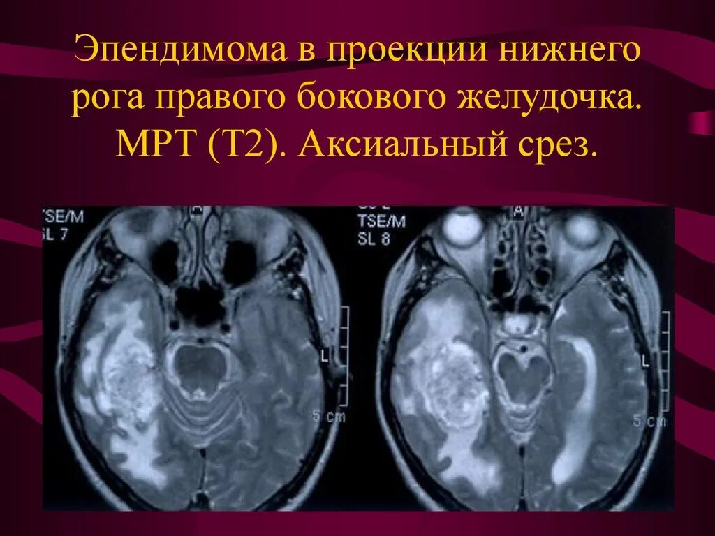 Эпендимома 4 желудочка головного мозга мрт. Эпендимома спинного мозга мрт. Миксопапиллярная эпендимома гистология. Эпендимома гистология. Эпендимома спинного мозга мрт.
