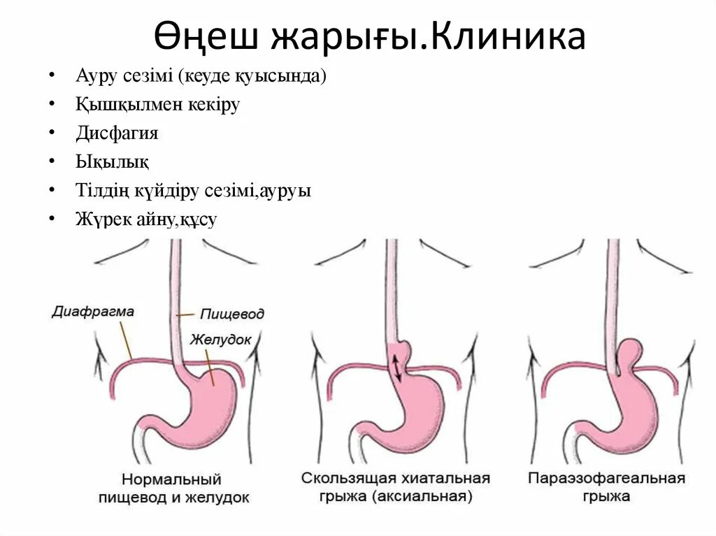 Грыжа пищевода показать. Грыжа пищеводного отверстия диафрагмы. Аксиальная хиатальная грыжа пищевода. Скользящая грыжа пищеводного отверстия диафрагмы 1 степени. Скользящая хиатальная грыжа.