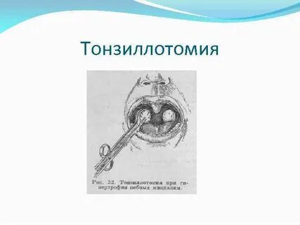 Гипертрофия небных миндалин код по мкб 10