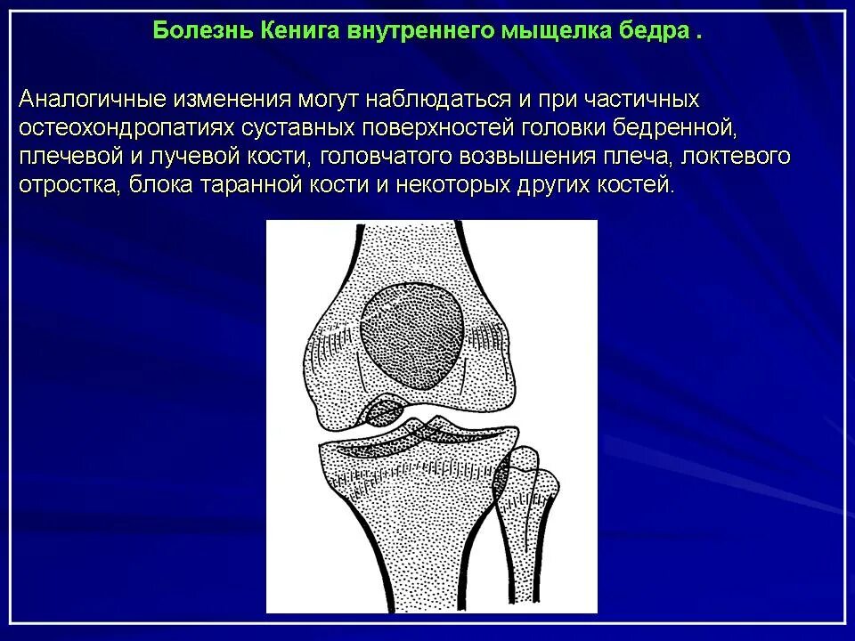 Асептический некроз мыщелка. Остеохондропатия Кенига. Остеохондропатия Паннера. Остеохондропатия коленного сустава. Остеохондропатия бедренной кости Кенига.