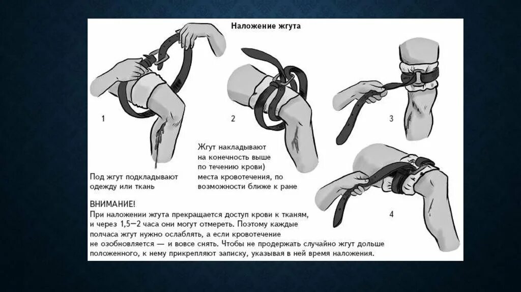 При каких кровотечениях необходимо наложить жгут. Этапы наложения кровоостанавливающего жгута. Порядок наложения кровоостанавливающего жгута на конечность. Техника наложения жгута Эсмарха. Наложение кровоостанавливающего жгута схема.