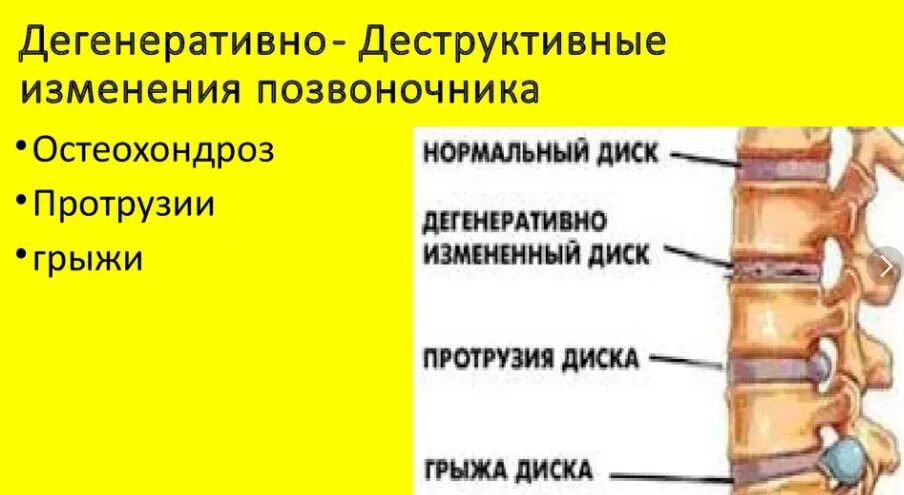 Спондилоартроз протрузии дисков спондилез. Дегенеративные изменения грудного отдела позвоночника. дегенеративные изменения грудного позвоночника. дегенеративные изменения дисков грудного отдела позвоночника. дегенеративно деструктивные изменения позвоночника.