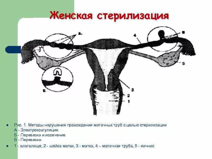 Как перевязывают трубы у женщин. Хирургическая стерилизация маточных труб. Перевязка маточных труб стерилизация. Стерилизация с иссечением маточных труб..