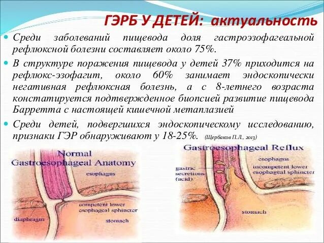 Как лечить рефлюксную болезнь. Рефлюксная болезнь у детей. гастроэзофагеальной рефлюксной болезни. гастроэзофагеальная рефлюксная болезнь у детей. изображение рефлюксной болезни.