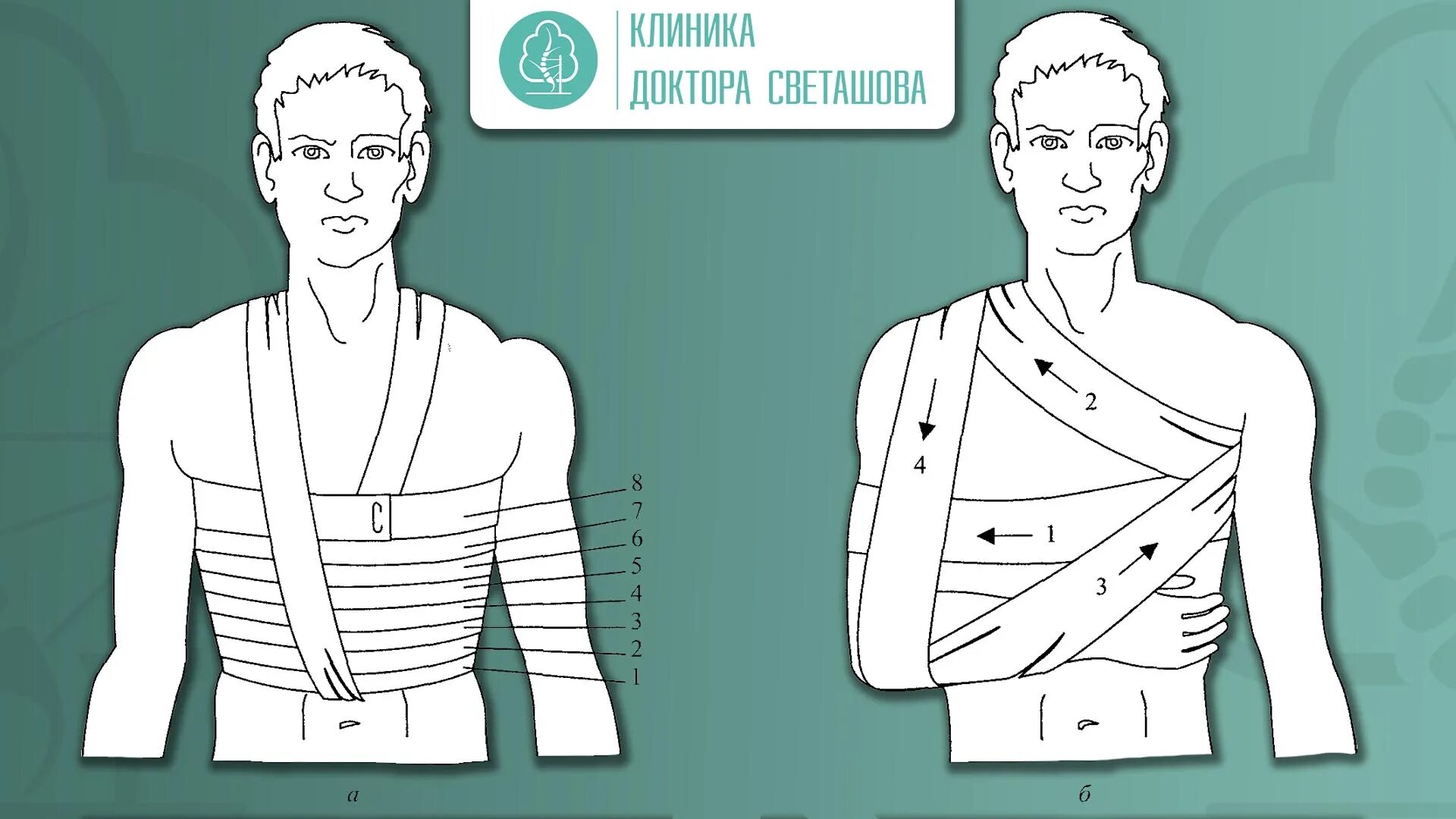 Вывих плеча помощь. Ключичная повязка. повязка при вывихе ключицы. вывих ключицы иммобилизация. повязка волковича при вывихе ключицы.