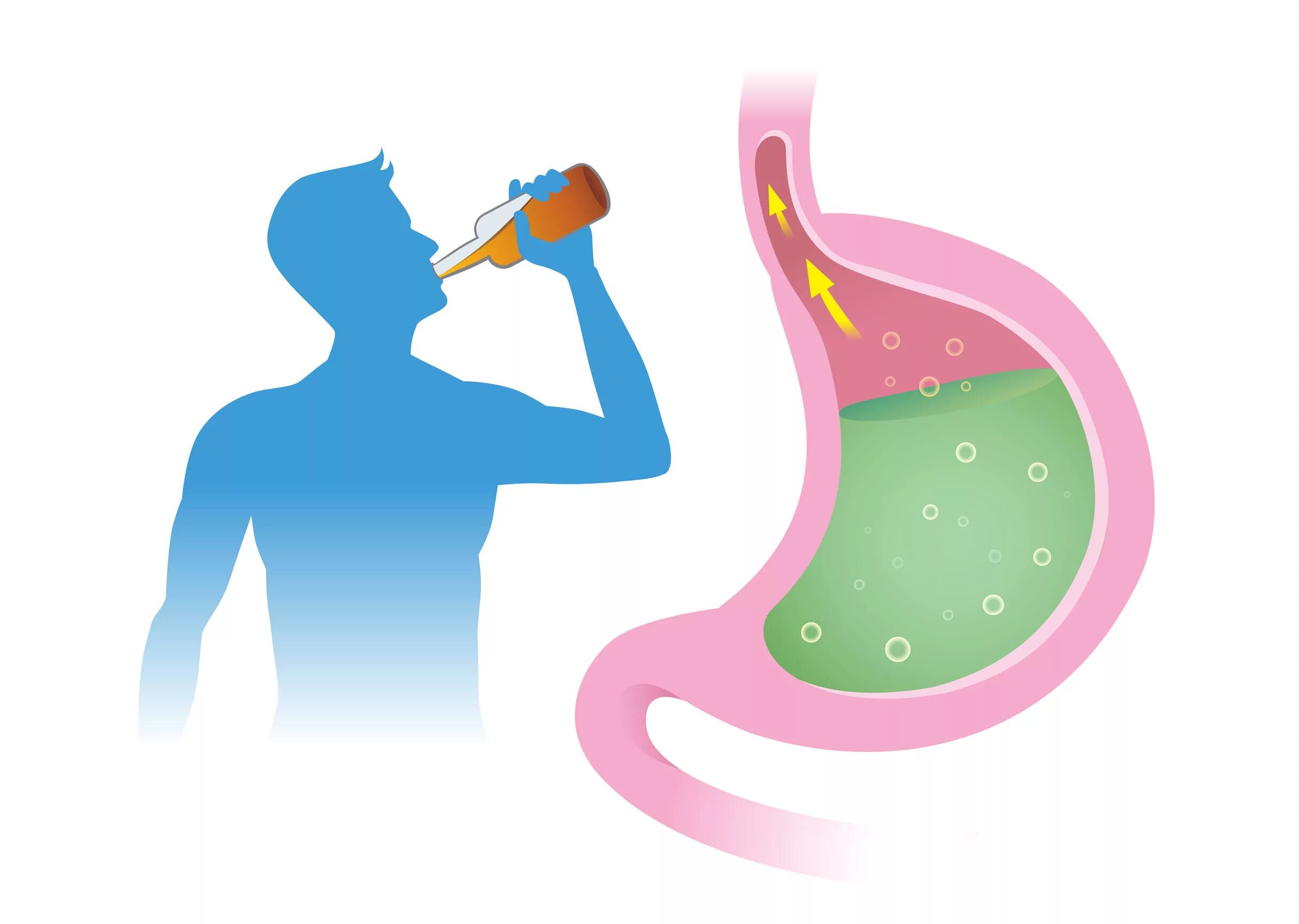 Желудочно-кишечный тракт алкоголика. Изжога при язве