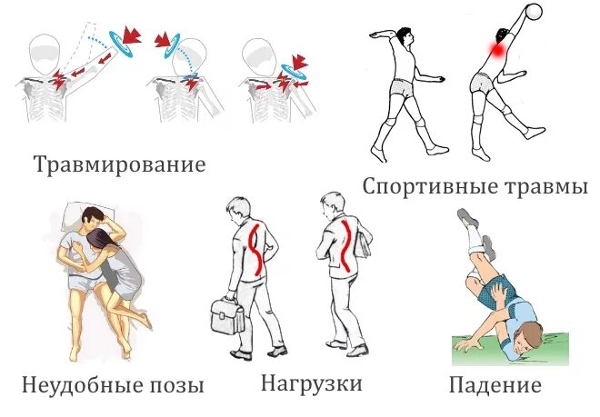 Боль в руке при поднятии и отведении. Болит плечевой сустав левой руки при поднятии. Боль при поднятии руки вверх в плечевом. Больно в плече при поднятии руки вверх. Поднятие руки в плечевом суставе.