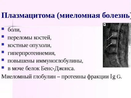Миеломная болезнь боли