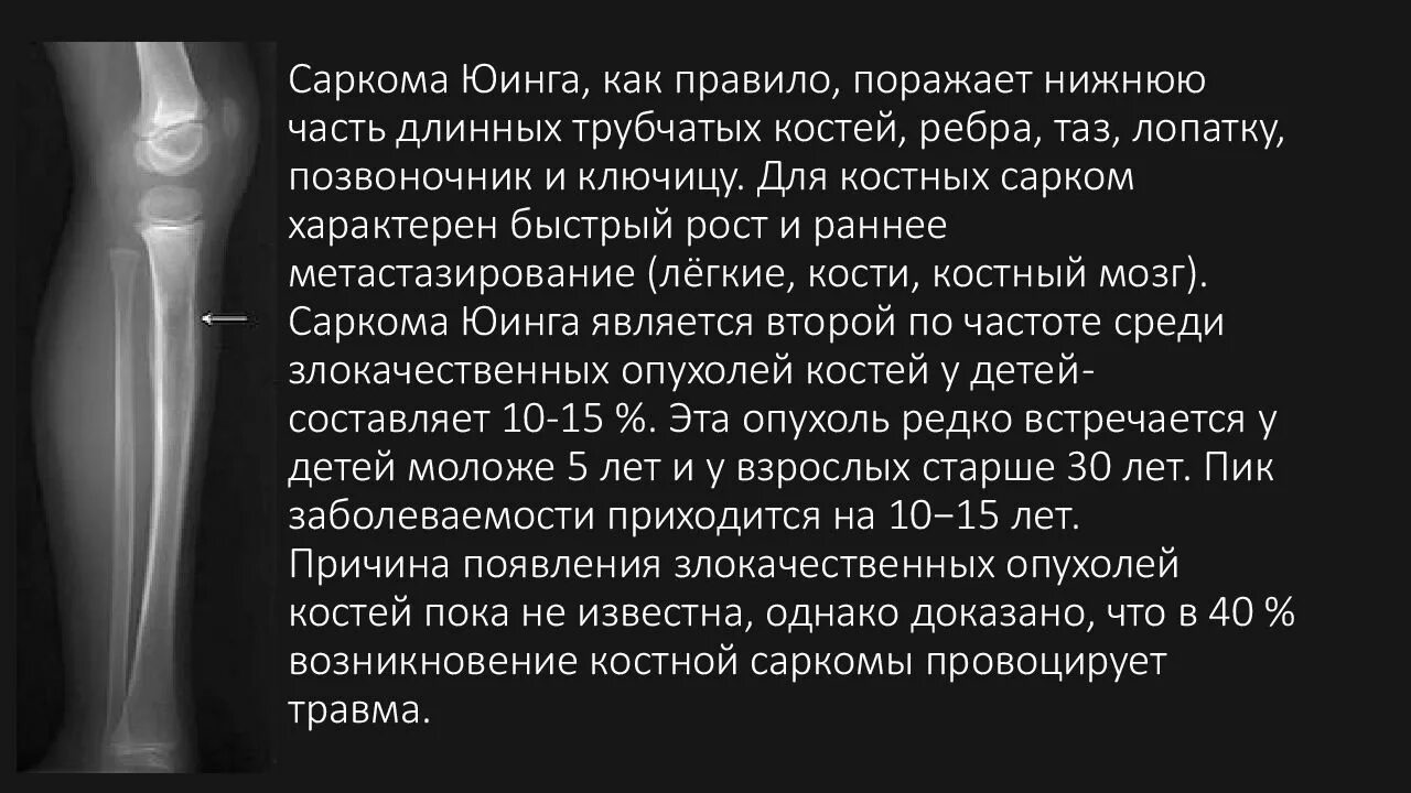 Рак костей можно вылечить