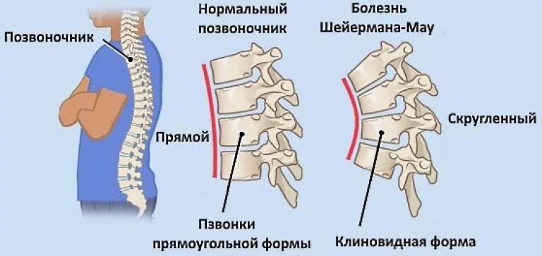 Болезнь шейермана мау что. Остеохондропатия позвонков болезнь шейермана-мау. заболевание позвоночника шейермана мау. исход болезни шойерман-мау что это. искривление позвоночника синдром шейермана мау.
