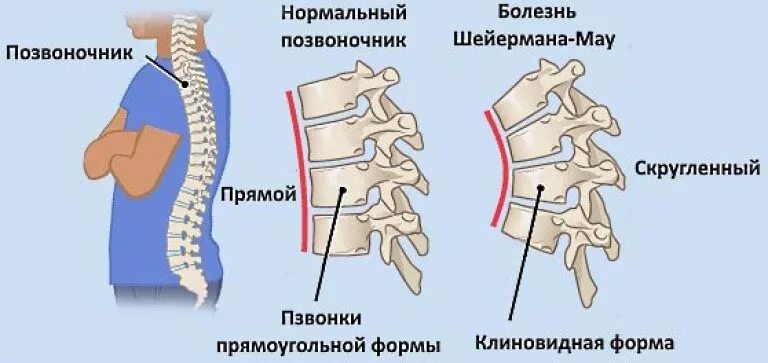 Остеохондропатия позвонков болезнь Шейермана-МАУ. Заболевание позвоночника Шейермана МАУ. Искривление позвоночника синдром Шейермана МАУ. Кифоз болезнь Шейермана-МАУ.