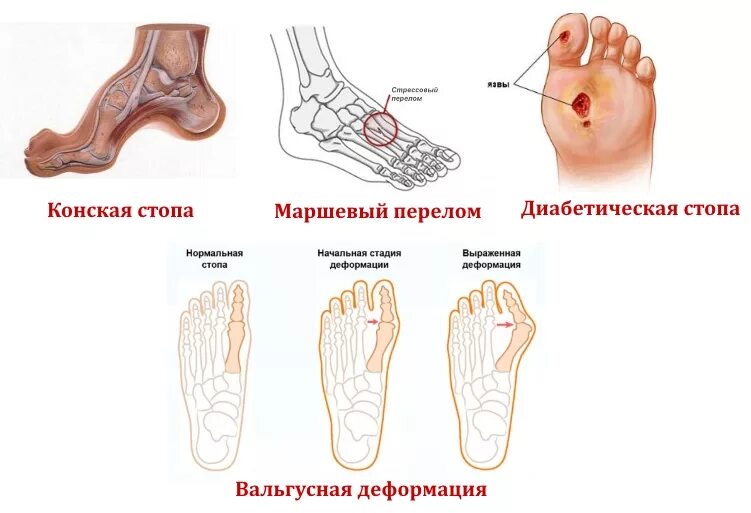 Болит стопа свод стопы.