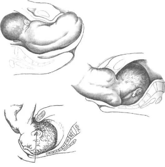Тазовое предлежание мальчика. Тазовое предлежание плода биомеханизм родов. Биомеханизм родов при тазовом предлежании. Ягодичное предлежание плода биомеханизм родов. Тазовое предлежание биомеханизм родов.