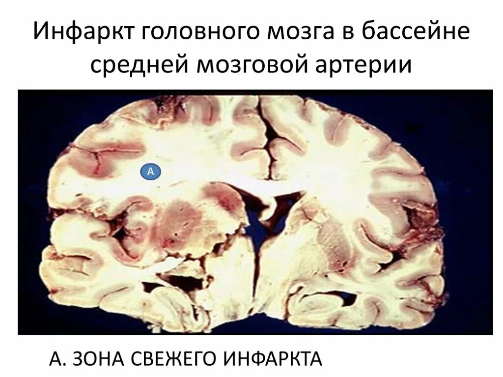 Инсульт в бассейне мозговой артерии. Ишемический инфаркт мозга. Патанатомия ишемического инсульта головного мозга. Инфаркт головного мозга макропрепарат. Ишемический инсульт макропрепарат.