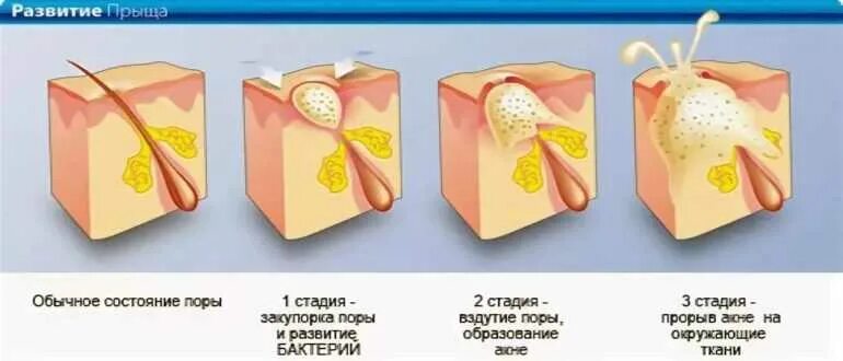 Стадии созревания чирия. Неприятная пора