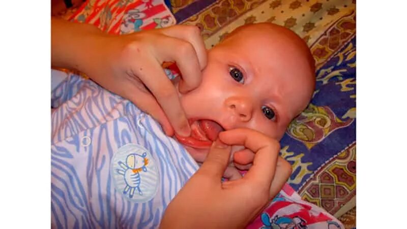 Набухание десен у младенцев. Прорезались зубы в 3 месяца.