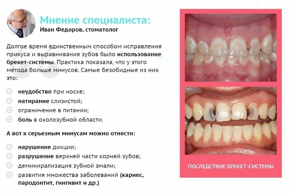 Капы для зубов отзывы. Брекеты для выравнивания прикуса. Трейнер для зубов до и после. Трейнер для зубов с брекетами.