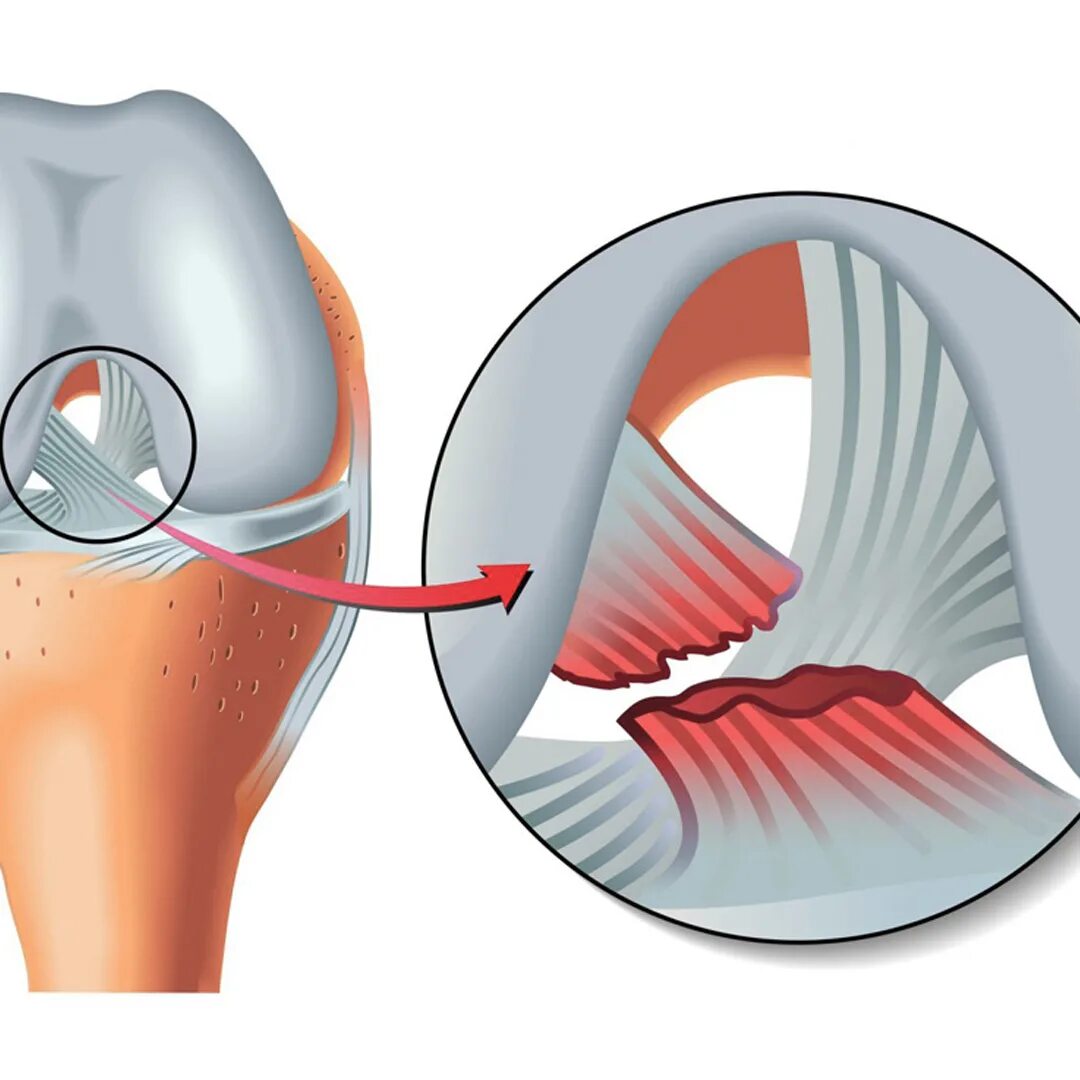 латеральная коллатеральная связка коленного сустава. разрыв связок коленного сустава боль. перерастяжение связок коленного сустава. повреждение коллатеральной связки коленного сустава. разрыв коллатеральной связки коленного сустава.