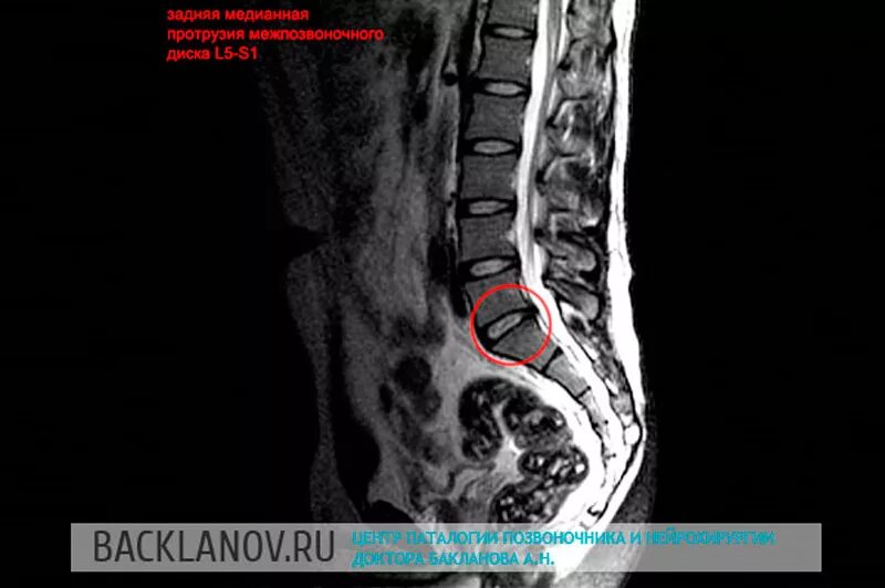 Дорзальная грыжа крестцового отдела поясничного. Экструзии дисков l3-s1. Дисков l4-s1 отдела позвоночника. Мрт протрузии позвонков l5 s1. Задняя Центральная протрузия диска l5-s1.