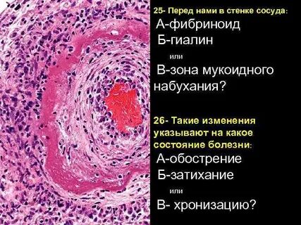 Фибриноид