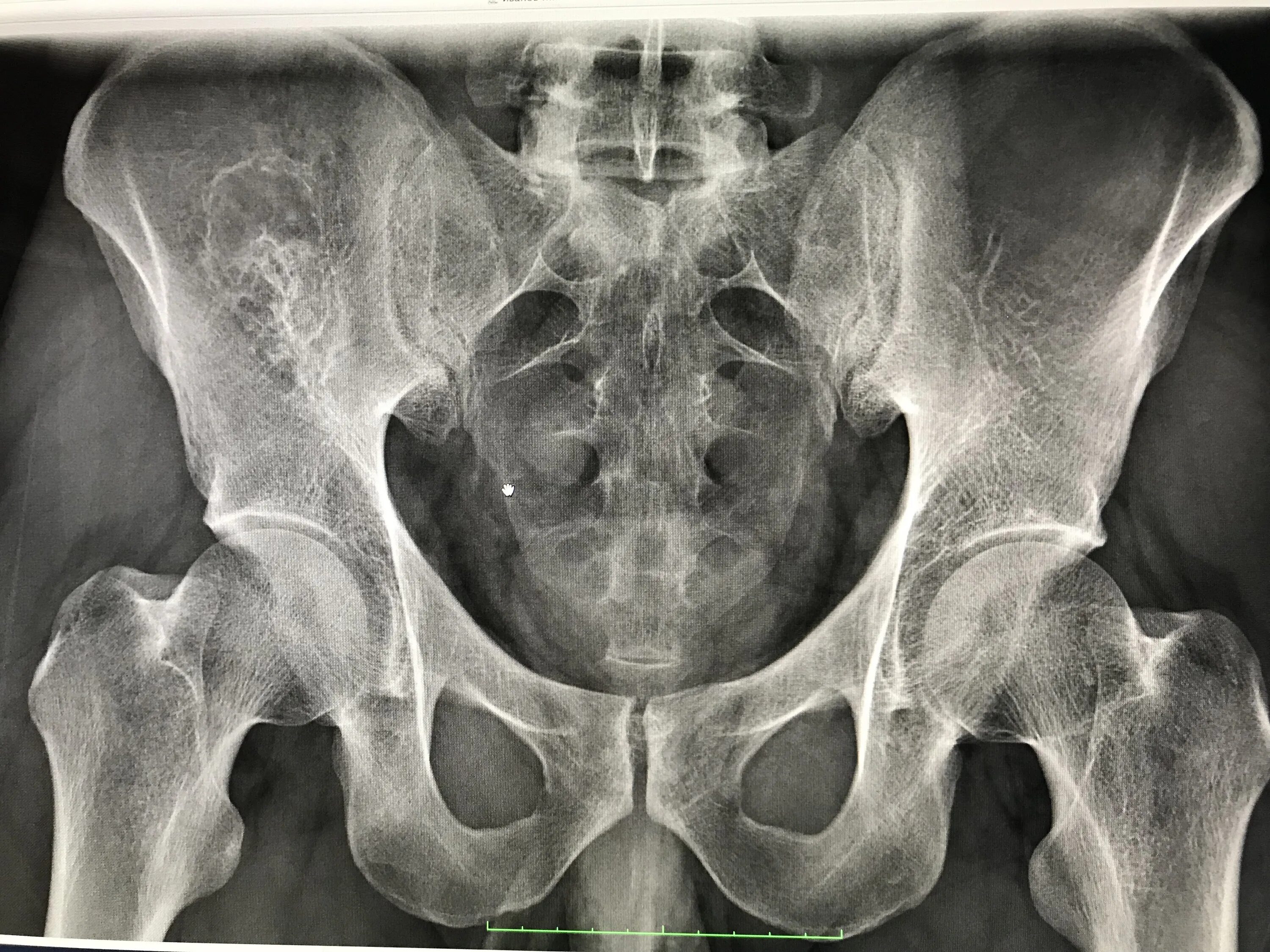 Кт подвздошной кости. Опухоль подвздошной кости рентген. Остеома костей таза рентген. Кт крестцово-подвздошных сочленений. Подвздошная кость остеома.