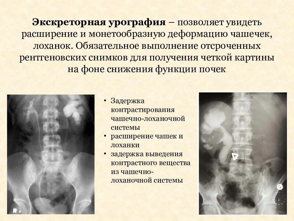 После урографии. После урографии