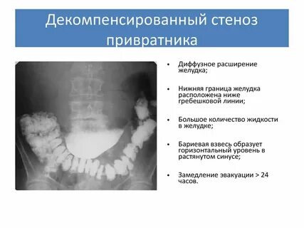 Достоверные клинические признаки стеноза привратника